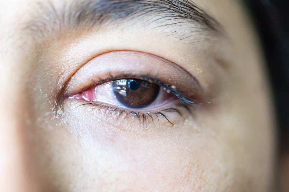 what-are-the-causes-of-watery-eyes-step-to-health